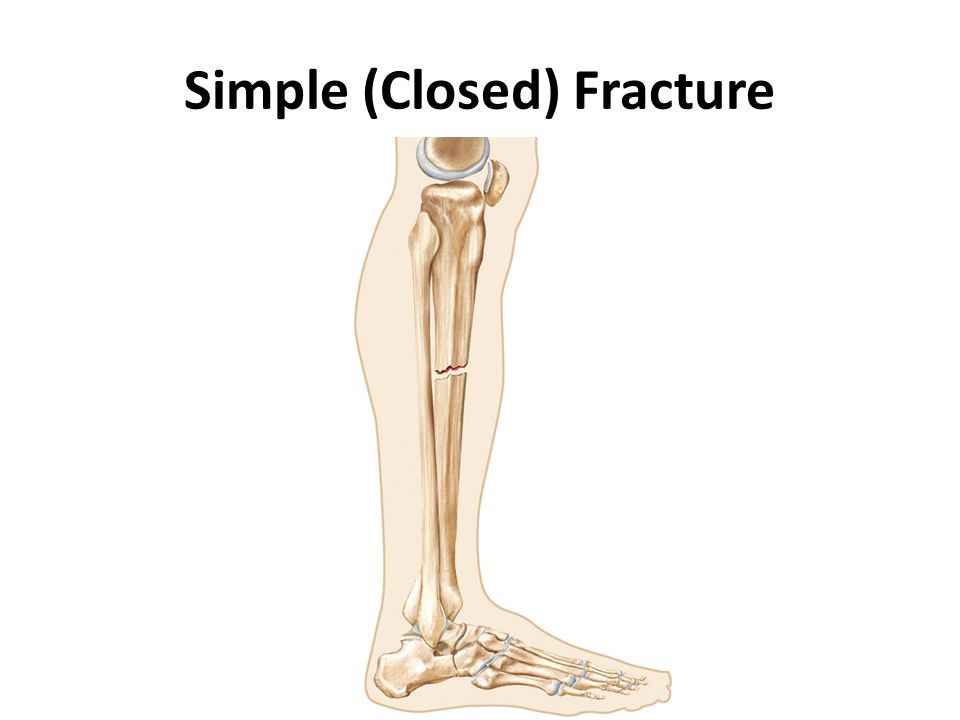 Bone Fractures. ppt video online download